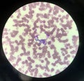 Yeast cells phagocytosis by white blood cell in blood smear