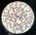 Yeast cells phagocytosis by white blood cell in blood smear