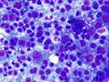 Histoplasma capsulatum in macrophages - cytology