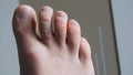 Yeast infection that occurs on the toes