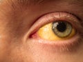 Yellow staining of the sclera of the eye in diseases of the liver, cirrhosis, hepatitis