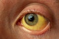 Yellow staining of the sclera of the eye in diseases of the liver, cirrhosis, hepatitis Royalty Free Stock Photo