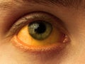 Yellow staining of the sclera of the eye in diseases of the liver, cirrhosis, hepatitis