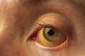 Yellow staining of the sclera of the eye in diseases of the liver, cirrhosis, hepatitis Royalty Free Stock Photo