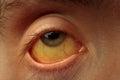 Yellow staining of the sclera of the eye in diseases of the liver, cirrhosis, hepatitis Royalty Free Stock Photo