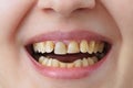 Yellow teeth of a caucasian woman before treatment and whitening of teeth, dental crowns Royalty Free Stock Photo