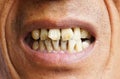 Yellow teeth