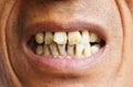 Yellow teeth Royalty Free Stock Photo