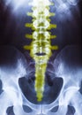 Yellow X-ray of the human lumbosacral pelvis and spinal column of adult people