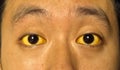 Yellowish discoloration of skin and sclera or deep jaundice in face of Southeast Asian young man. Royalty Free Stock Photo