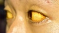 Yellowish discoloration of skin and sclera or deep jaundice in face of Southeast Asian young man.