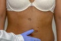 Dermatologist checking the benign moles,