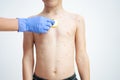 Young boy having chickenpox pictures of skin Royalty Free Stock Photo