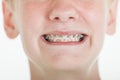 Young boy showing off his orthodontic braces Royalty Free Stock Photo