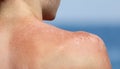 Young boy skin is peeling after sunburn Royalty Free Stock Photo