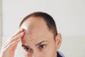 Young caucasian man looking at mirror worried about balding. Royalty Free Stock Photo