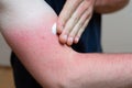 Young caucasian man with sunburn red skin arms applying sunscreen cream Royalty Free Stock Photo