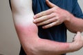 Young caucasian man with sunburn red skin arms Royalty Free Stock Photo