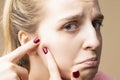 Skin Care Ideas. Young Emotional Caucasian Blond Woman With Skin Problems Squeezing Pustules By Fingers On Beige