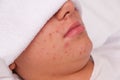 Acne. Close-up. Problematic skin in adolescents. cheeks and chin Royalty Free Stock Photo