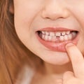 Young girl point on milk tooth. Baby losing teeth Royalty Free Stock Photo