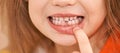 Young girl point on milk tooth. Baby losing teeth Royalty Free Stock Photo