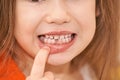 Young girl point on milk tooth. Baby losing teeth
