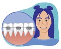 Young girl smiles with braces on teeth as a concept of orthodontic services, flat vector stock illustration with woman and braces