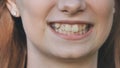 A young girl smiles and shows her crooked teeth.