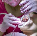 Dental examination. Patient with braces and cheek retractor