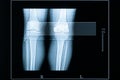 Young Male left and right knees CT scan. Medical and healthcare imagery with scale in centimeters
