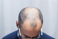 Young man with alopecia looking at his head and hair in the mirror Royalty Free Stock Photo