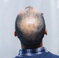 Young man with alopecia looking at his head and hair in the mirror Royalty Free Stock Photo