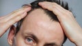 Young man with bald spots suffering from hair loss, Royalty Free Stock Photo