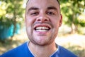 Young man with a chipped tooth Royalty Free Stock Photo