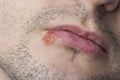 Young man with cold sore Royalty Free Stock Photo