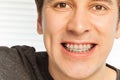 Young man with dental braces on his teeth