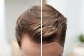 Young man before and after hair loss treatment against blurred background Royalty Free Stock Photo