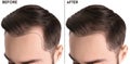 Young man before and after hair loss treatment against white background Royalty Free Stock Photo