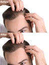 Young man before and after hair loss treatment Royalty Free Stock Photo