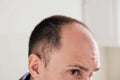 Young man looking at mirror worry about balding