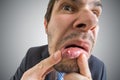Young man is looking on ulcer or blister in his mouth in mirror
