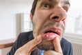 Young man is looking on ulcer or blister in his mouth in mirror Royalty Free Stock Photo