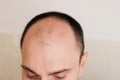 Young caucasian man looking at mirror worried about balding. Royalty Free Stock Photo