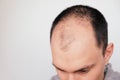 Young man losing hair on temples, close up Royalty Free Stock Photo