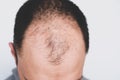 Young man losing hair on temples, close up Royalty Free Stock Photo