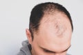 Young man losing hair on temples, close up Royalty Free Stock Photo