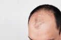 Young man losing hair on temples, close up Royalty Free Stock Photo