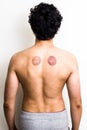 Young man with marks from cupping therapy