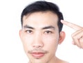 Young man serious hair loss problem for health care medical and shampoo product concept, selective focus Royalty Free Stock Photo